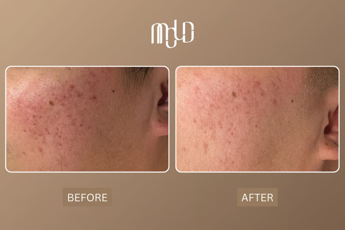 Over 100 Clients Successfully Treated for Acne Scars at Mold Manila Through Science-Led, Personalized Care